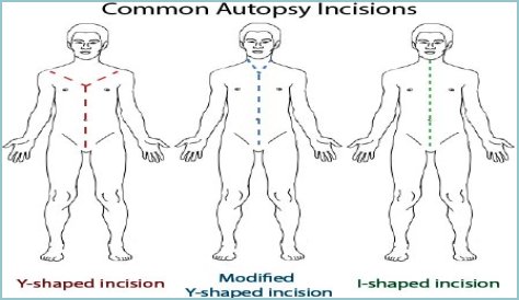 Autopsy Definition Debate: Is it Time for a Modern Update?